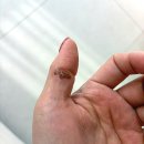 가톨릭권정형외과의원 | 😭 지옥의 통증, 대상포진 생생 후기 &amp; 스치기만 해도 아픈 이유? (초기 증상, 치료 골든타임 총정리)