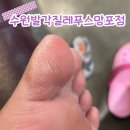 수원 발각질제거 발뒤꿈치 변색 해결 후기 (찐 내돈내산)