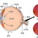 안압이 높을때 나타나는 증상과 ★ '안압'을 낮추는 방법 이미지