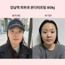 온다하우스 | 강남역 온다리프팅 후기이중턱살 리프팅 효과, 유지기간, 주기 총정리