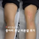 스킨52 과천지사 | 부천 튼살커버 스킨52 종아리 튼살 리본셀 PDRN 재생앰플 관리 후기