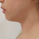 레알성형외과의원 | [내돈내산]광주 블리비 슈링크 / 인모드 / 점제거 후기