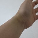 을지병원 택시승차장 앞 | 25.12.20 충수염(맹장염) 수술(+의정부을지병원 후기)