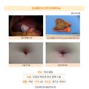 담낭폴립수술후기. 단일공복강경수술을 받았는데 신속하고 통증도 거의 없는 편이라 매우 만족하게 생각합니다. 이미지