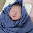 희망반점 | 신생아 밀크반점 백일 아기 치료 시작 : 포토나 레이저 10회차 전후비교