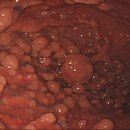위 용종 (Gastric Polyp) &amp; 위 선종 (Gastric Adenoma) 이미지