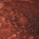 위 용종 (Gastric Polyp) & 위 선종 (Gastric Adenoma) 이미지