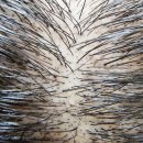 월드베스트의원 | 원주 smp 두피문신, 이렇게 변화됩니다. (후기사진O)