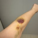 내안에유산부인과의원 | 함춘여성의원 습관성유산 검사(유전자검사 정상)