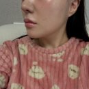 플레저성형외과의원 | 강남 얼굴 이중턱 지방분해주사후기 ㅣ 온다 리프팅과 함께한 리얼 변화