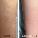 윤한의원 | 부산피부한의원 모공각화증 치료 후윤필 2회차 후기