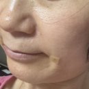 팔자주름 필러 내돈내산 후기 피부과 고르는 꿀팁 01.필러 편(feat. 50대 팔자주름 필러/레디어스...