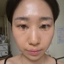 멍 - 통영시 평인일주로 870 | 파주 피부과 스킨보톡스 통증 효과 멍없는 후기