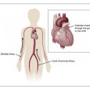 Re:Angiogram (Cardiac Catheterization) 이미지