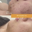 힐메디의원 네이버블로그