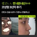 [광고X]찐 내돈내산 코성형 3년차 후기 (콧대+비주+기증늑연골+콧볼축소) + 코끝처짐 ? ...ㅠㅠ