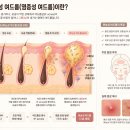 휴약국 | 대전여드름약 피부과 처방 필독! 이소티논 vs 항생제 총정리
