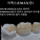 e푸른치과의원 | [서울/강남] 오늘의 치과 인레이 잘하는곳 내돈내산 솔직후기