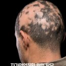 자가면역질환 원형 탈모, 왜 생기고 어떻게 대응할 수 있을까?