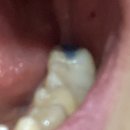 미르치과병원 | 어금니 레진이 떨어졌다.. (반전있음) 포항미르치과 인레이 진료 가격 후기