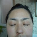 IPL procedure (아이피엘 시술) 이미지