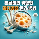 골다공증 유발 음식과 위험성, 예방법 및 도움이 되는 음식 이미지