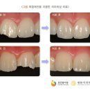 레진필링[치아 충전 또는 수복 재료 중 치과용 레진을 치아에 직접 수복하는 충전치료] 이미지