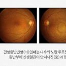 황반변성 영양제 의심 증상, 원인, 예방안 총정리 이미지