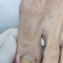 곡성-131 | 순천 무좀 | 풋살 후 멍 방치 | 두꺼워진 무좀발톱 관리
