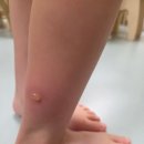 버그싹 | 모기 침 제거 안티버그 사용 후기