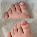 대전 문제성 발관리 오네뜨뷰티 내성발톱 교정후기