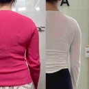 삼일팔 | 여름 상체 다이어트 수원 팔뚝 지방추출주사 당일~3개월 총정리 솔직후기