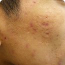 휴본한의원 | 휴본한의원에 다니면서 파인흉터 치료 받은 후기