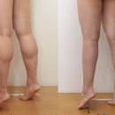 고려메디칼의원 | 종아리얇아지는방법으로 비절개종아리퇴축술과 성형법 - 세이지의원