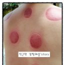 주식회사 센스메디칼 | 서울부항기*실리콘부항기 구입후,사용후기