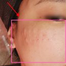 하늘한방소아과한방재활의학과한의원 | 기미치료피부과 내돈내산 후기 엑소좀시술 한의원피부관리 유명한곳 (통증, 주기, 과정)