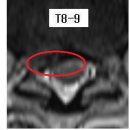 fefe1025 님의 흉추디스크 T8-9, T9-10의 mri사진 판독입니다. 이미지
