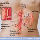 Intestinal ischemia 이미지
