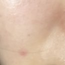 리즈 | 고주파 리즈엘 후기 4개월 이용한 내돈내산 솔직후기 광고아님