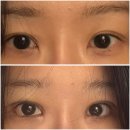 해뜰동물병원 | 내돈내산 쌍수 후기, 쌍수절개 붓기 기록 (재수술)👁️