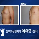 이것만알면 여유증이 두렵지않다! 왜?? 여유증 발병원인~ 이미지