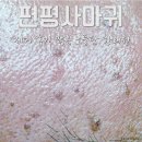 노들담한의원 | 편평사마귀 제거 후기 많은 곳에서 치료하세요!