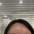 샤인약국 | 역시 기다림이 답🤍 신촌피부과 리쥬란물광 + 더마샤인 7일차 후기