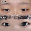 제이티성형외과의원 | 무쌍 쌍꺼풀 수술 후기[자연유착 눈매교정+앞트임] 제이티 김진성 원장