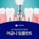 디에스다솜치과 어금니 임플란트 어렵게 여겨지는 이유와 개선 방안
