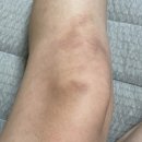 (유)대한청정환경 | 무릎관절염증상 50대