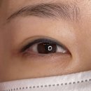 양산신-1024 | [창원/마산] 아이라인 문신 제거 1~3차 후기 문신제거 잘하는 곳 '제시뷰티 마산점'