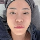 SRS | [ 리쥬란 힐러 4cc + SRS레이져] 후기: 색소침착과 건조인들에게 희망을