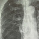 15년간 폐암 추적해보니… 발생률 상승↑, 5년 생존율 2배↑ 이미지