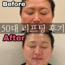 스킨바이블 | 50대 리프팅 후기 신도림윤곽관리 스킨바이블 신도림
